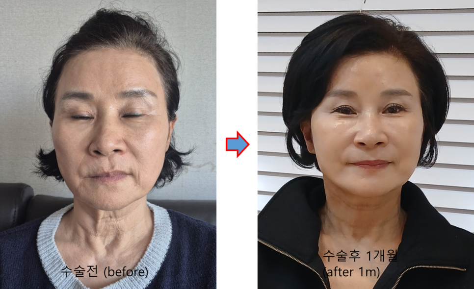 &ldquo;목이 나이를 결정한다: 안면거상과 함께 목거상을 해야 하는 이유&rdquo; 관련 이미지 5