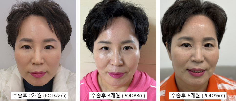 Mother’s Day Top Pick for a Gratitude-Driven Facial Procedure: The Recovery Process After Lower Blepharoplasty A to Z image 4