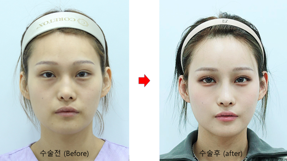 자연스러운 볼륨감을 위한 지방이식 관련 이미지 8
