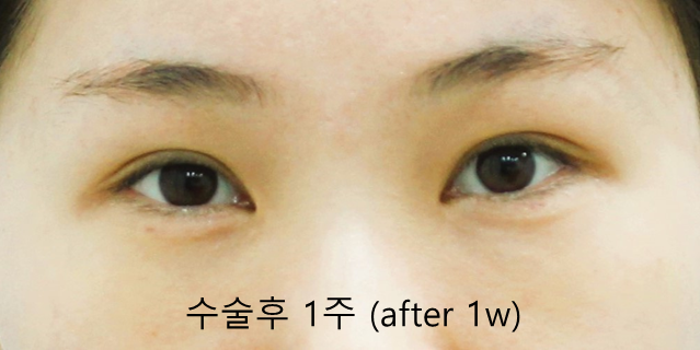 Under-Eye Fat Repositioning and Aegyo-Sal Fat Grafting image 9