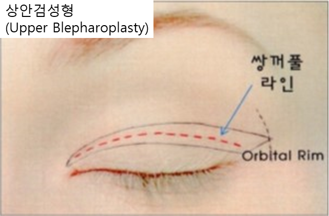 상안검 수술 후에도 눈이 불편하다면? &ndash; 눈 재수술과 이마거상을 함께 하는 이유 관련 이미지 1