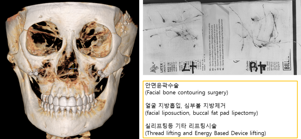 안면윤곽수술 후 피부처짐, 맞춤형 거상수술이 필요한 이유 관련 이미지 2