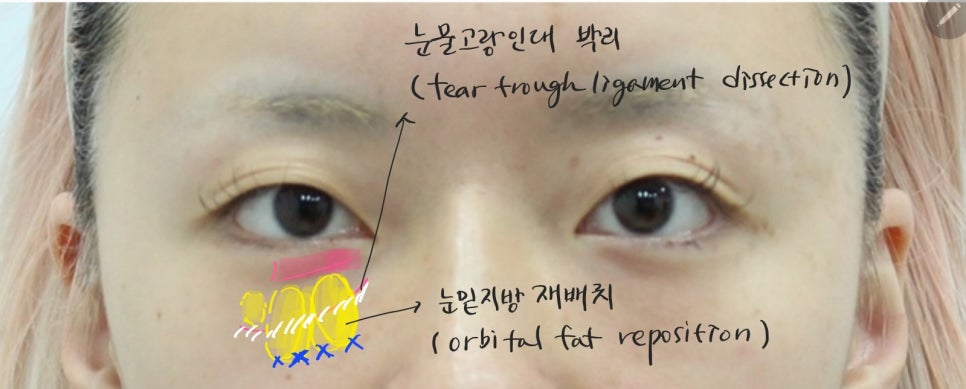 눈밑지방재배치의 회복기간 관련 이미지 4