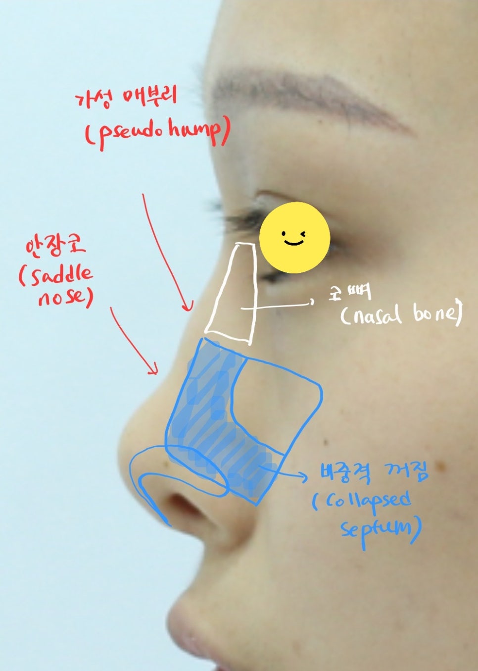Rib Cartilage Rhinoplasty for a Deviated Saddle Nose image 3