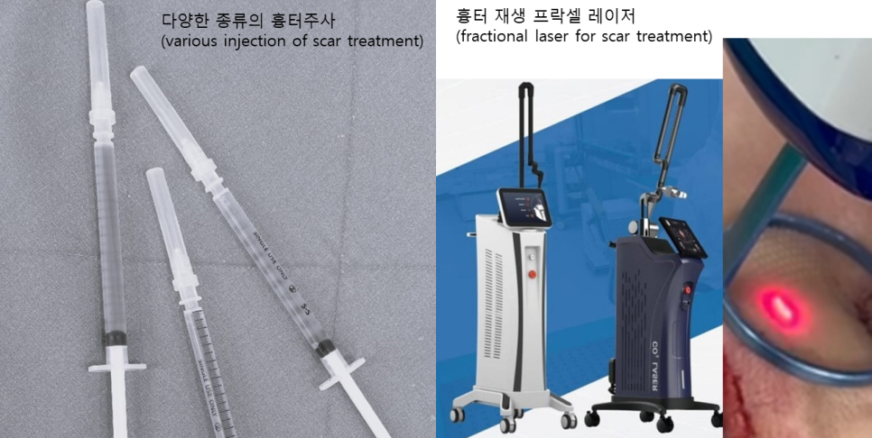 안면거상 후 흉터, 얼마나 남을까요? 흉터의 변화와 관리법 관련 이미지 4