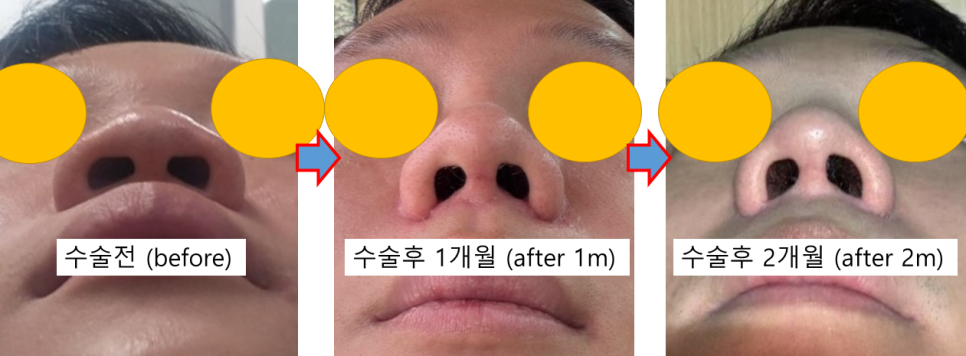 남자 복코 성형, 두꺼운 코끝을 자연스럽게 개선하기 관련 이미지 4
