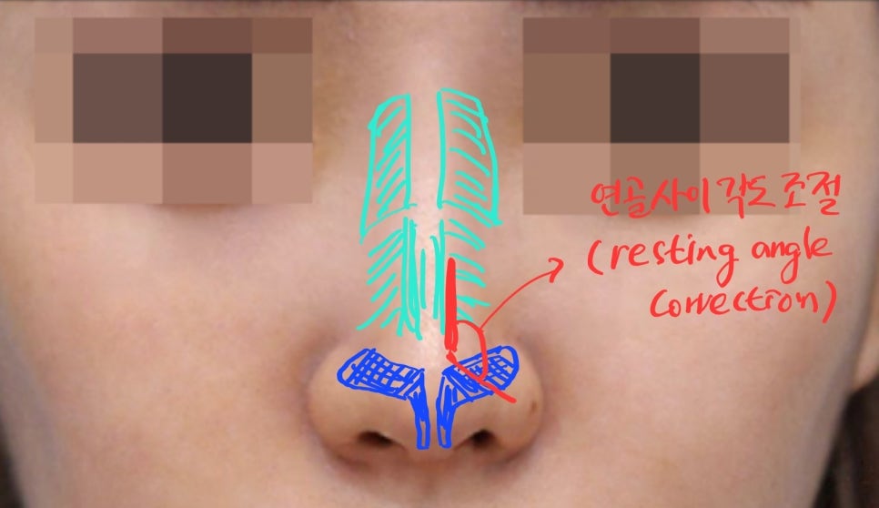 Various Nasal Tip Procedures for Bulbous Nose Correction image 4