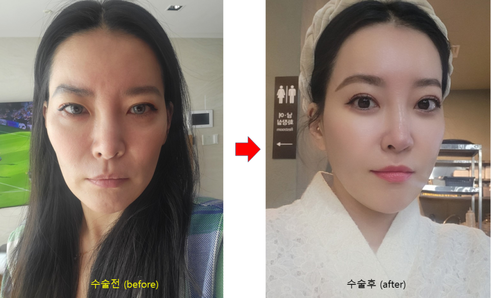 PRP Fat Grafting to Correct a Peanut-Shaped Face image 8