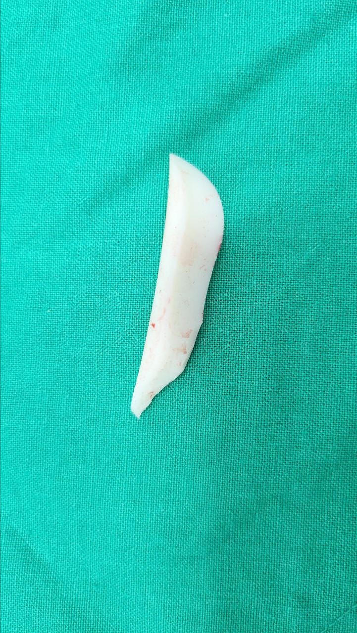 Rib Cartilage Nose Revision Surgery for Bird Beak Deformity image 3