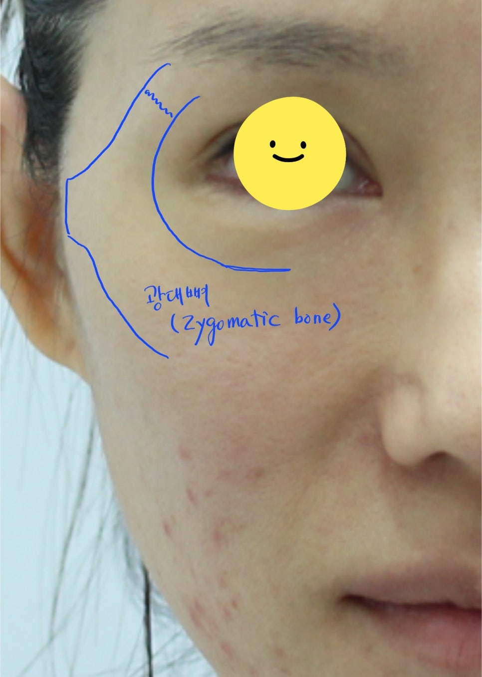 A Specialized Fat Grafting Correction Method for Hollowed Side Cheeks image 1