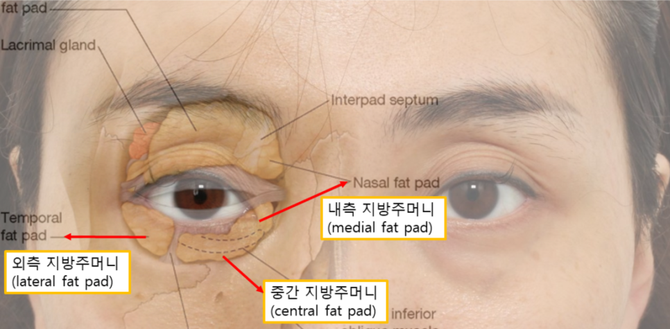 여름휴가 성형, 직장인에게 인기 있는 눈밑지방재배치(Hamra법) 관련 이미지 2
