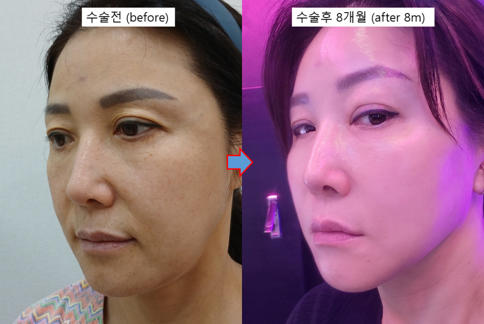 안면거상의 완성도를 높이는 펠리컨 수술 관련 이미지 4