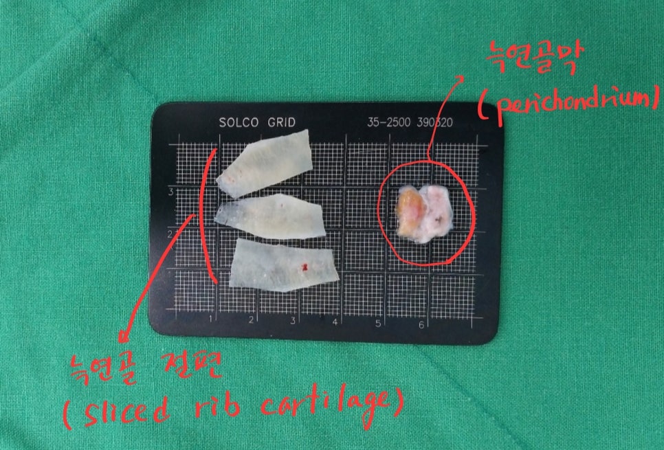 자가늑연골을 이용한 코 재수술 관련 이미지 4