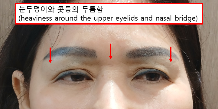 복합적인 눈 문제, 하나의 수술보다 원인별 교정이 중요한 이유 관련 이미지 4