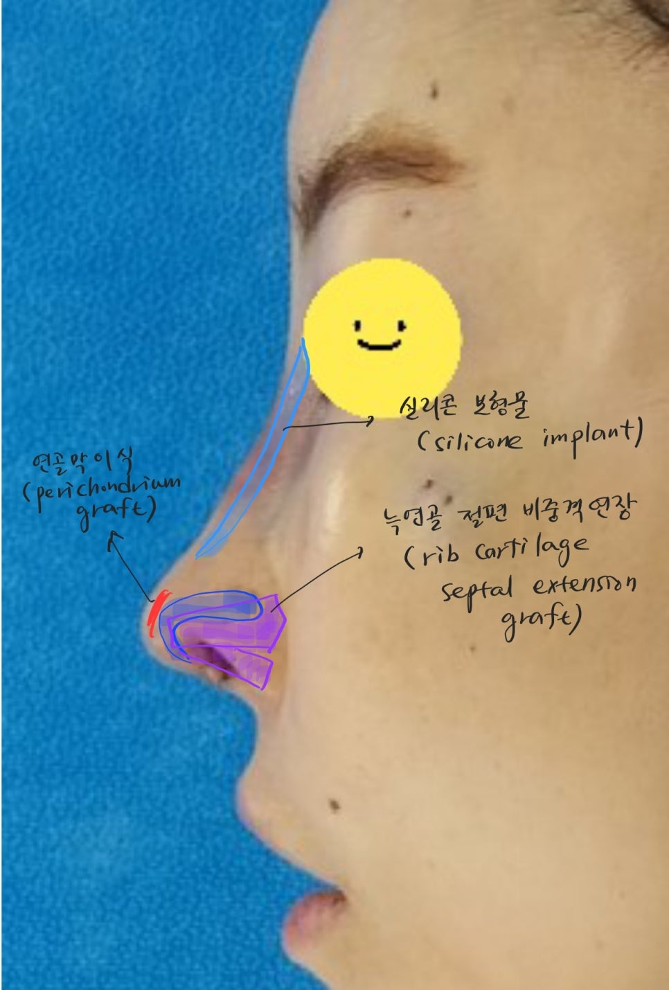 코끝떨어짐 늑연골 재수술 관련 이미지 6