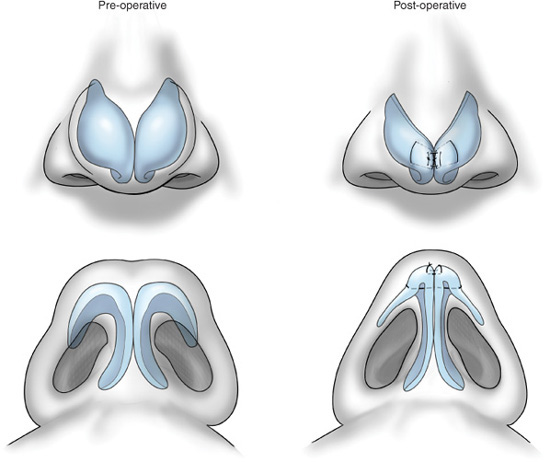 Correction of a Pinched Nose or Indented Nose image 1