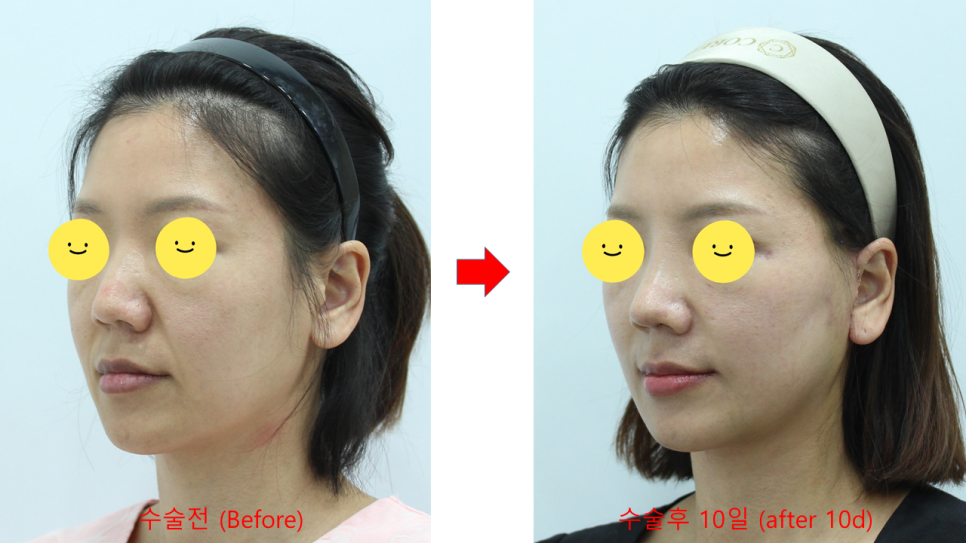 Recovery Period for Midlife Nose Surgery image 4