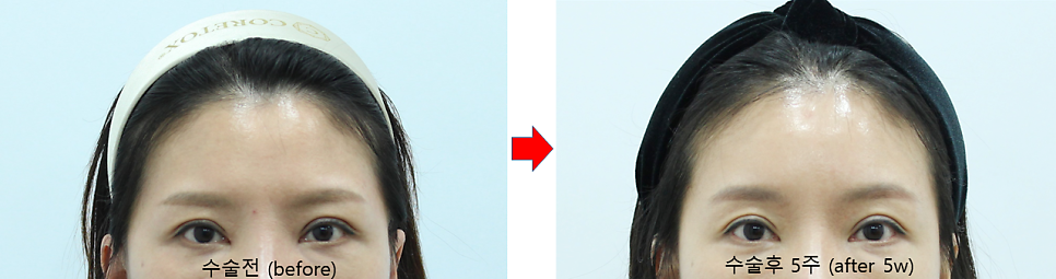 Forehead Lift After Upper Blepharoplasty image 8