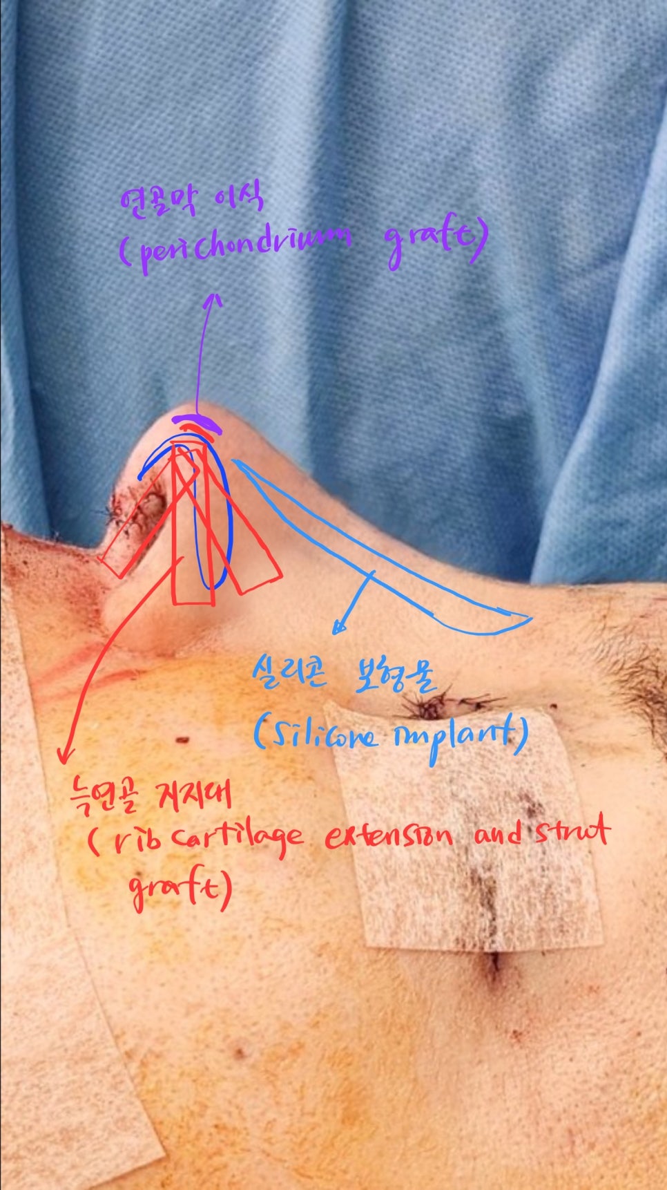 Rib Cartilage Nose Revision Surgery for Bird Beak Deformity image 7
