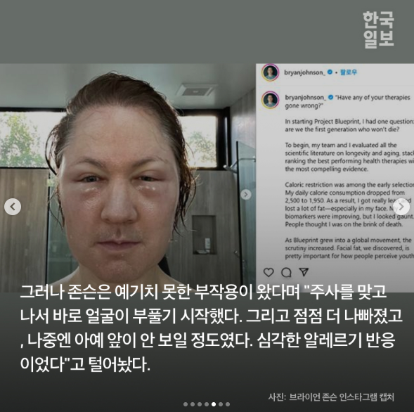 레누바(Renuva)와 줄기세포 지방이식 관련 이미지 5