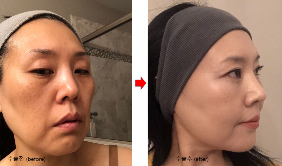 북미교포 성형수술. 해외교포(동포)성형 관련 이미지 9