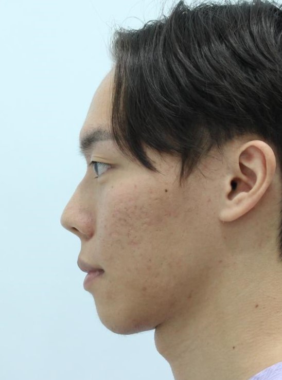 코뼈를 깎지 않는 코성형? 3D CT 맞춤형 코보형물 관련 이미지 1