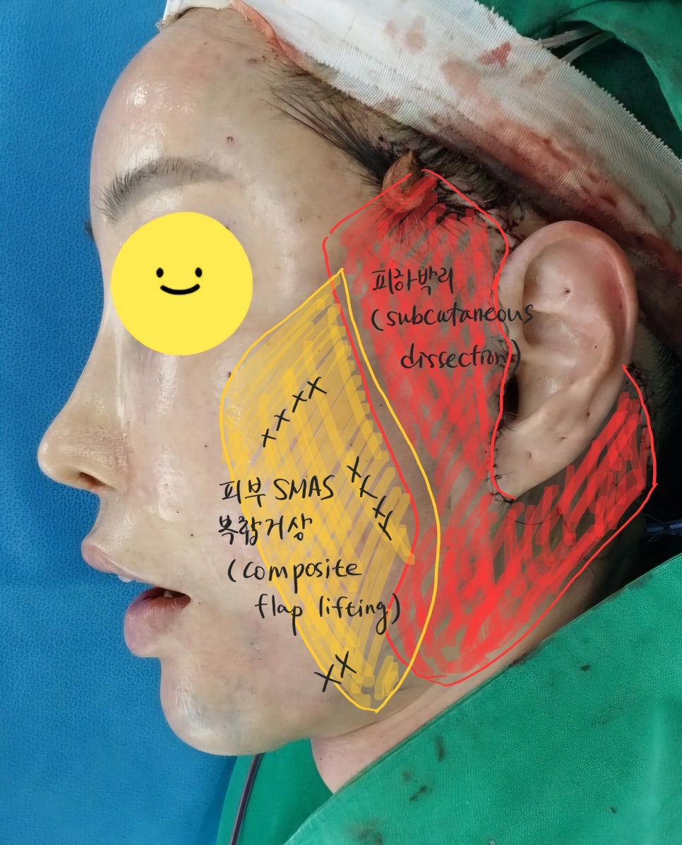 안면거상 재수술에서 수술 방법의 선택 관련 이미지 6