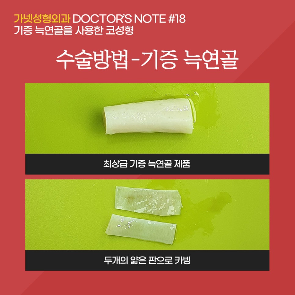[Garnet Plastic Surgery Director Baek In-soo's Plastic Surgery Column] Rhinoplasty Using Donated Rib Cartilage image 4