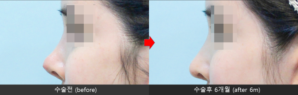 Nasal Tip Skin Irritation Caused by L-Shaped Silicone image 9