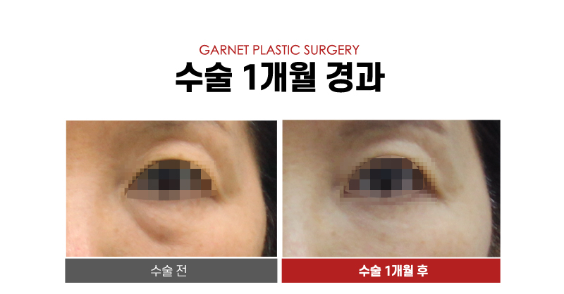 압구정역성형외과에서 알아보는 대표적인 동안성형 종류! 관련 이미지 7