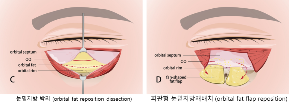 눈밑지방재배치와 애교살지방이식의 유지기간 관련 이미지 2
