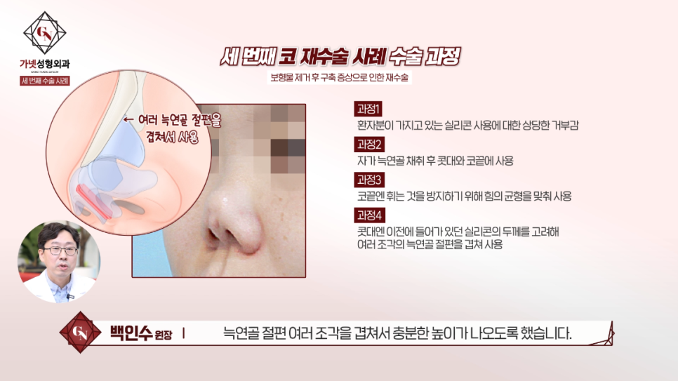 Why You Should Have Revision Rhinoplasty at a Place That Specializes in Apgujeong Nose Revision Surgery (ft. Dr. Baek In-soo) image 9