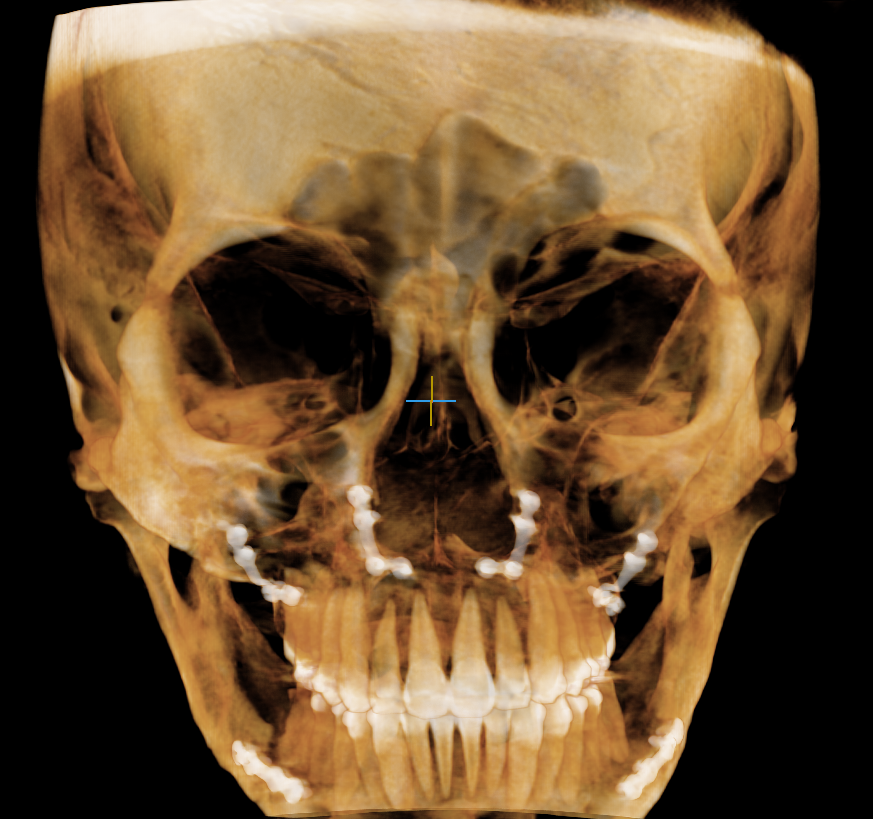 Sagging Skin After Facial Contouring Surgery (Cheek Sagging) image 3