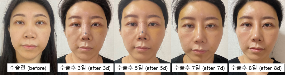 Rhinoplasty + Forehead Fat Grafting: Why the Face’s Mood Changes image 5