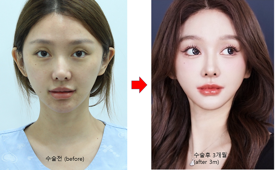 레누바(Renuva)와 줄기세포 지방이식 관련 이미지 10
