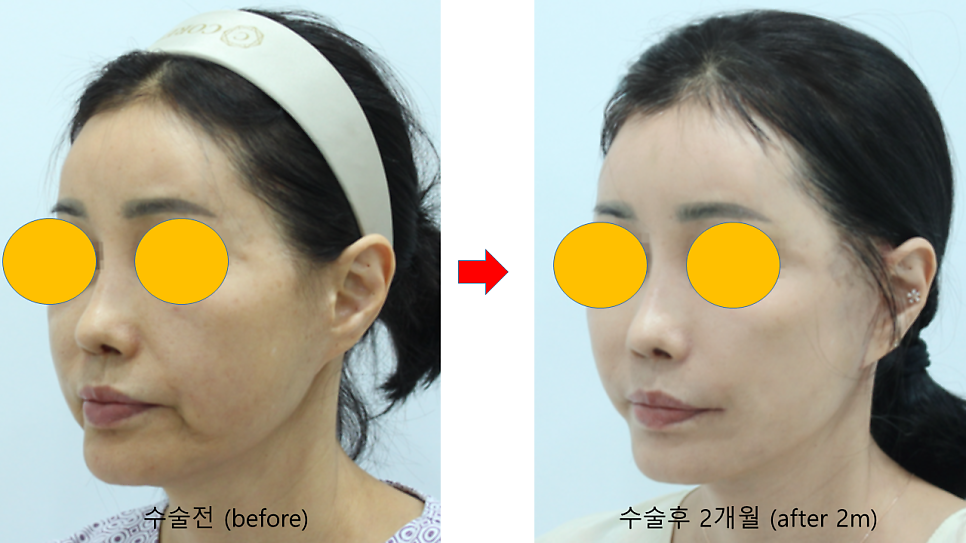 안면거상 재수술에서 수술 방법의 선택 관련 이미지 9