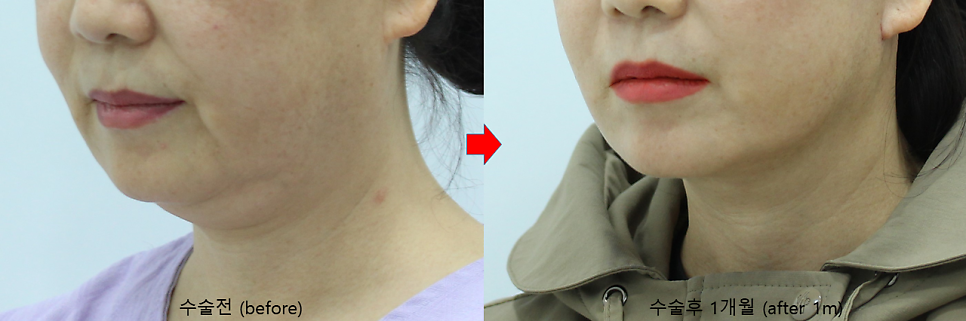 안면거상과 함께하는 목거상술 관련 이미지 5