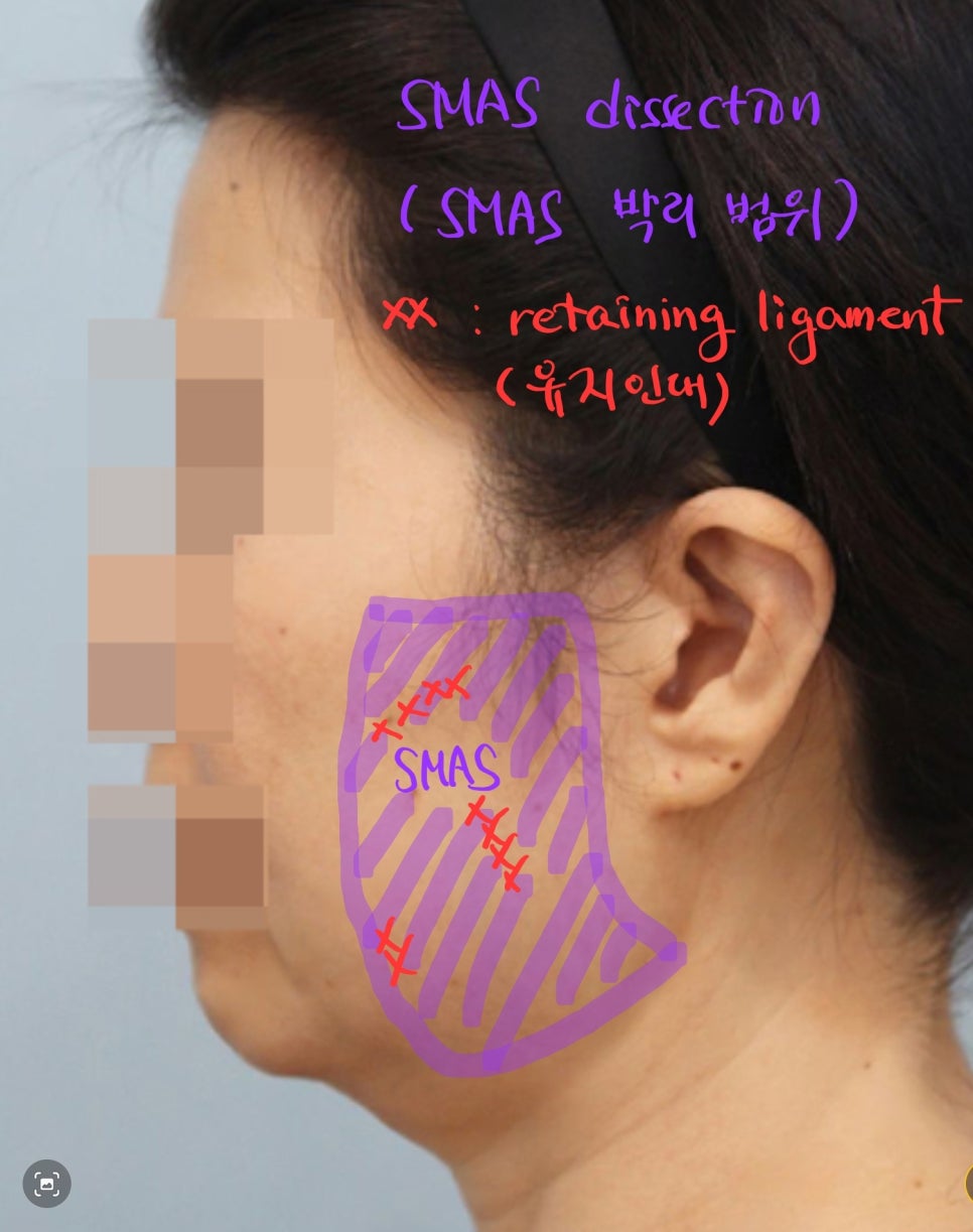 Dissection Range in Facelift Surgery image 3