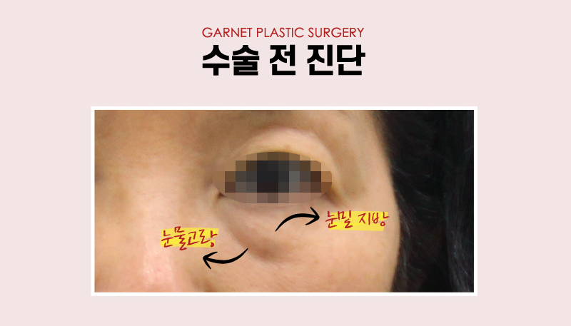 【Garnet Plastic Surgery Director Insoo Baek’s Plastic Surgery Column】 Lower Blepharoplasty Case in a Woman in Her Late 50s image 3