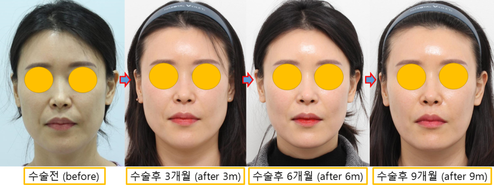 얼굴 지방이식 유지기간, 3·6·9개월 경과로 알아보는 생착과정 관련 이미지 7