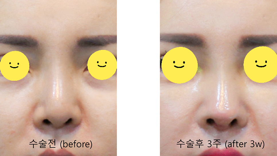트렌드 변화에 따른 중년코 재수술 관련 이미지 6