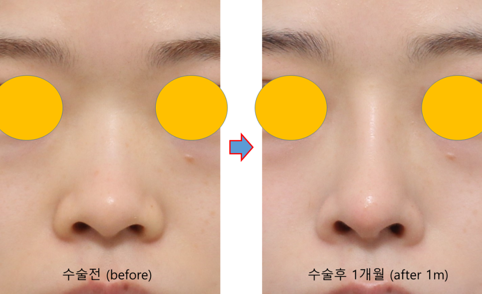 How to Naturally Enhance a Small Nose in Your First Nose Surgery image 2
