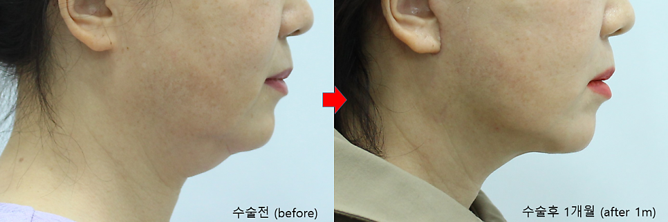 안면거상과 함께하는 목거상술 관련 이미지 8