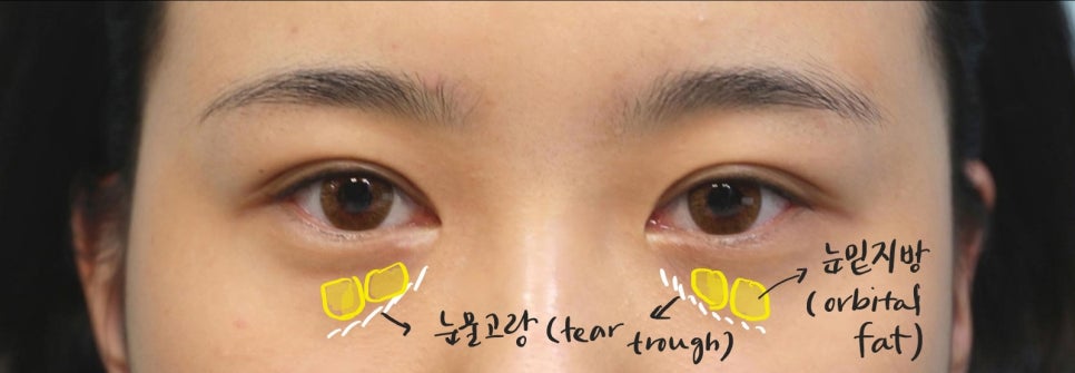 Lateral and Lower Canthoplasty with Under-Eye Fat Repositioning image 2