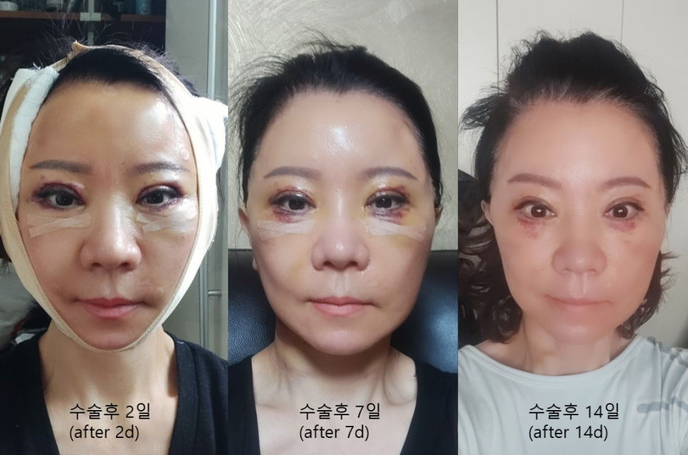 After a Face Lift, When Will Swelling and Bruising Go Away? Recovery Process and Natural Results image 2