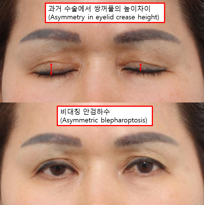복합적인 눈 문제, 하나의 수술보다 원인별 교정이 중요한 이유 관련 이미지 2