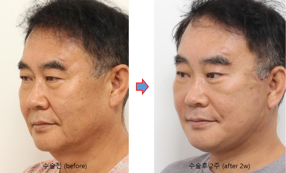 60대 남자 거상수술, 브래드 피트와 비슷한 나이의 실제 수술 사례 관련 이미지 8