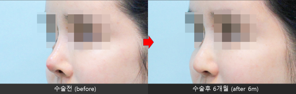 Nasal Tip Skin Irritation Caused by L-Shaped Silicone image 8