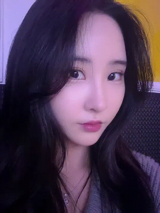 안검하수가 동반된 짝눈의 쌍꺼풀 재수술 관련 이미지 10