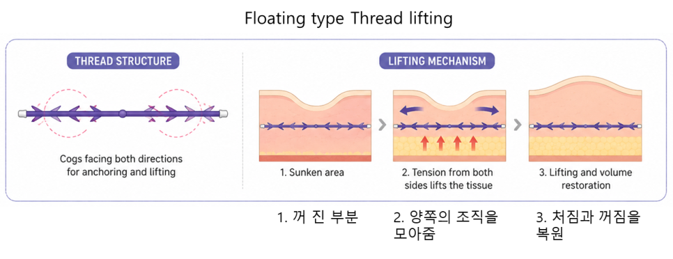 실리프팅, 어떤 실을 어떻게 사용하느냐가 중요한 이유 관련 이미지 4